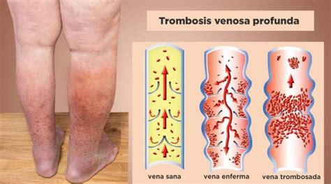 trombosis en la pierna